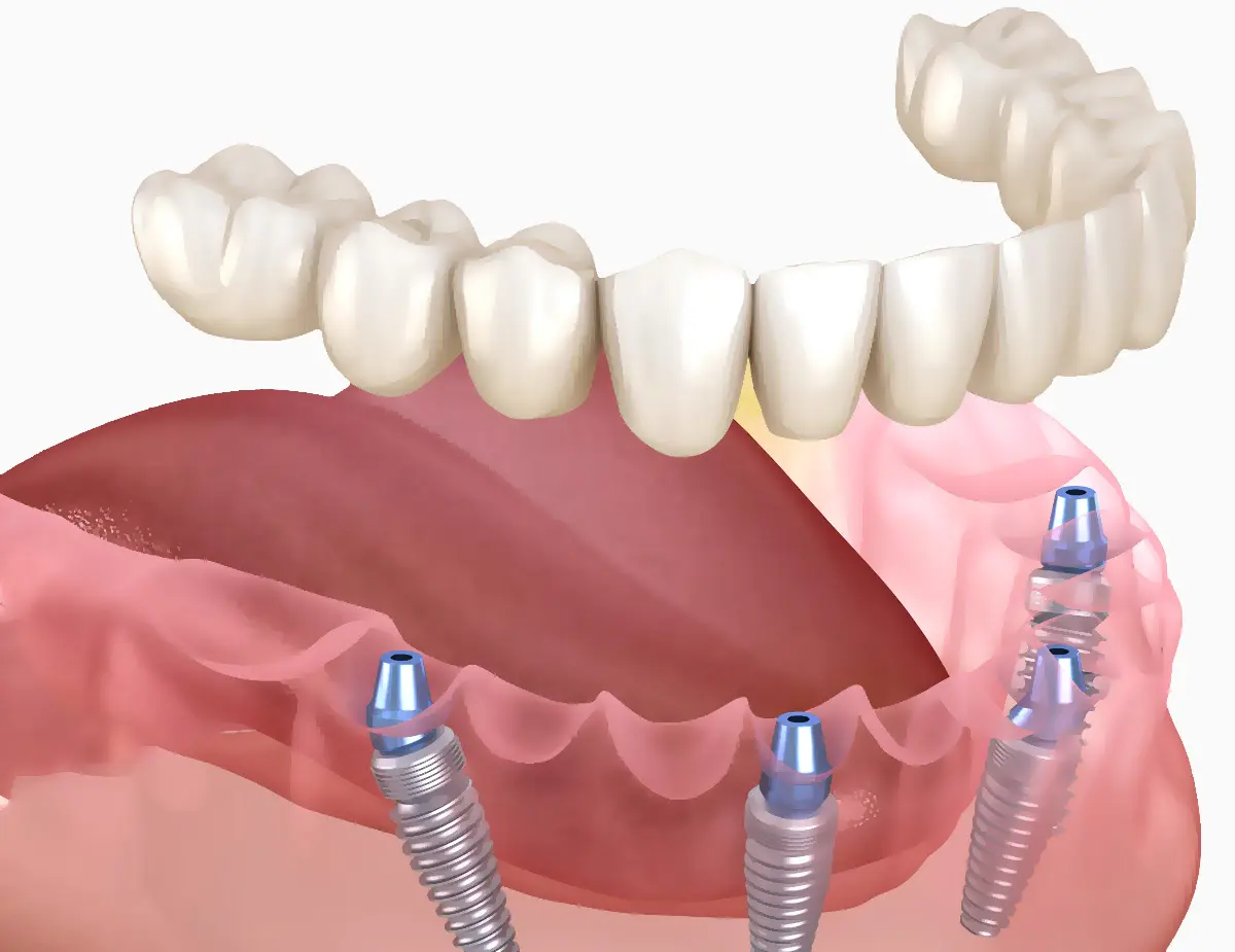 Protetika na implantatima