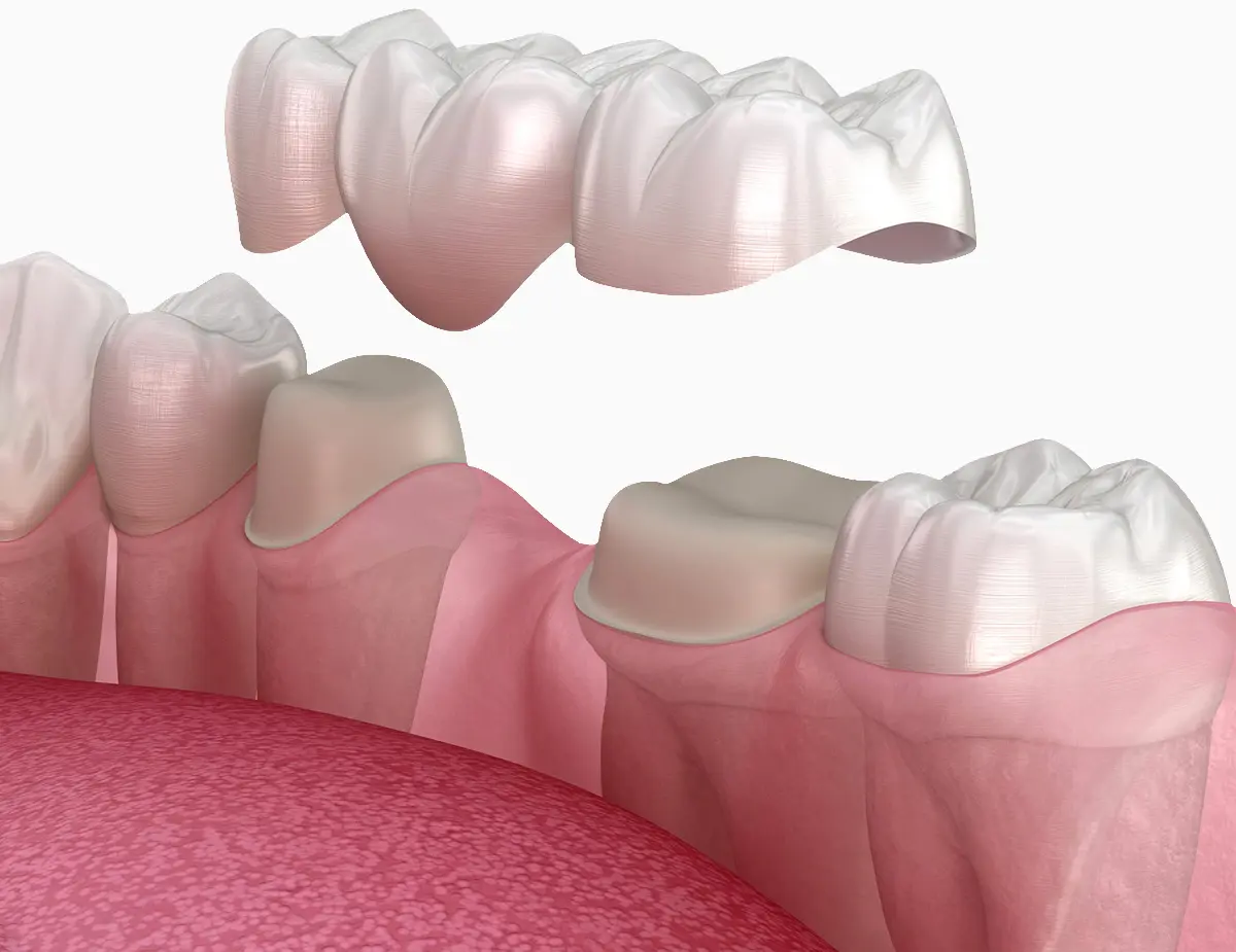 Protetika na prirodnim zubima